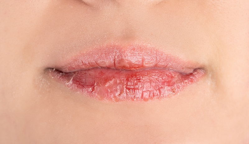 Entzündete Lippen